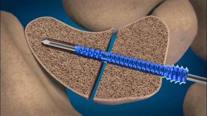 REDUCT Headless Compression Screw