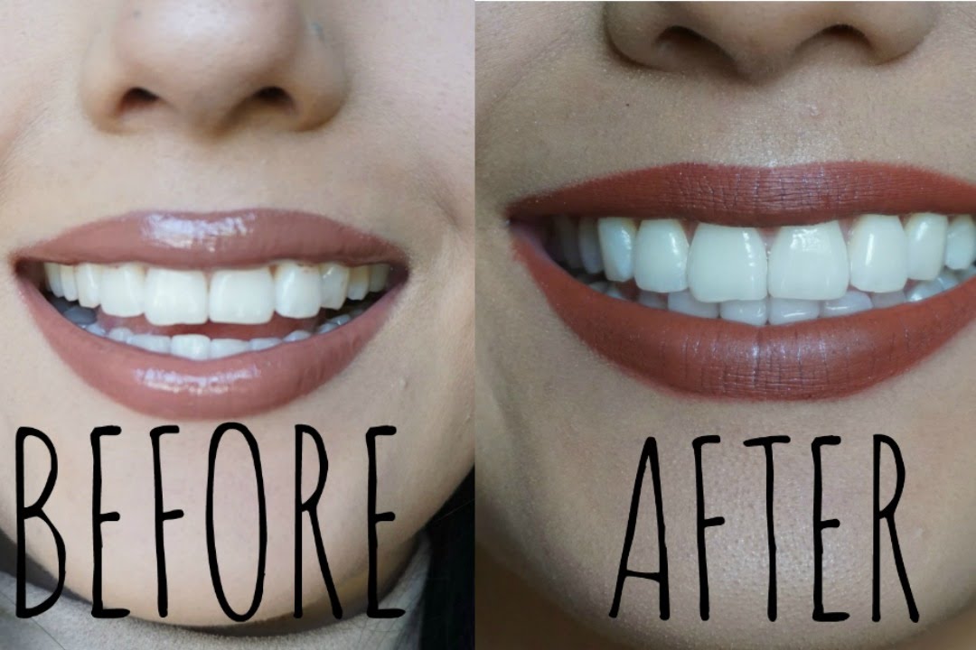 HOW TO WHITEN YOUR TEETH AT HOME | GIVEAWAY SMILE BRILLIANT [CLOSED ...