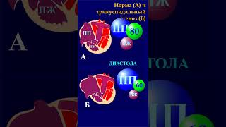 Гемодинамика при трикуспидальном стенозе и в норме. #shorts