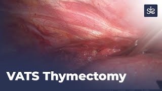 Video Assisted Thoracoscopic (VATS) Thymectomy - Thymus Surgery | Smart Lung Surgery
