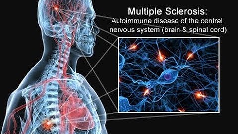 Multiple Sclerosis MS- A Brain and Spinal Cord Disease