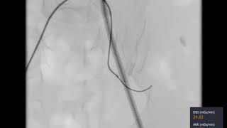 Mentice Vascular Trauma Management   Product Video   short version