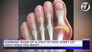 Warning Signs of a Gout Attact: Don't let Gout Hold you Back! | TVJ News