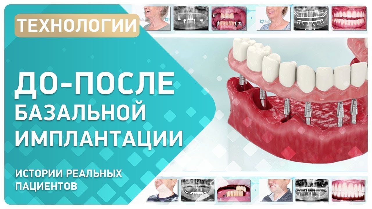 Базальная имплантация 👉 реальные пациенты ДО и ПОСЛЕ - YouTube