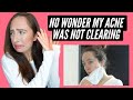 REACTING TO *My Old Skincare Routine* When I Had Acne! 💀