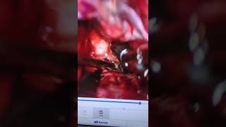 Ruptured Brain Aneurysm treatment #Best Neurosurgeon in Indore #Best Brain surgeon in Indore