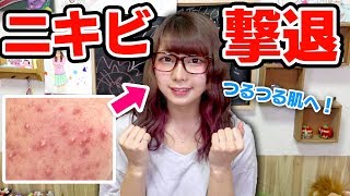 ニキビ0！痕が残らないニキビの治す方法とスキンケアのやり方！/洗顔、化粧水で対策！