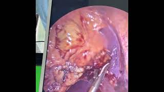 Minimal invasive liver tumor ablation surgery جراحات اورام الكبد بالمنظار