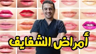 اخطر امراض الشفاه 🥺 ( تغير لون الشفاه دليل على إصابة الجسم بالأمراض )