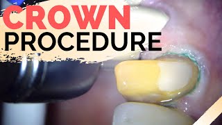 Dental Crown Explained  | Anterior Crown Preparation