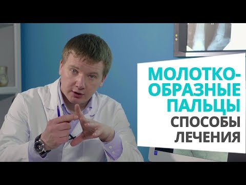 Видео: Можно ли вылечить брахидактилию?