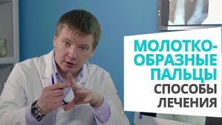 Способы лечения молоткообразной деформации пальцев доктор Алексей Олейник #footclinic