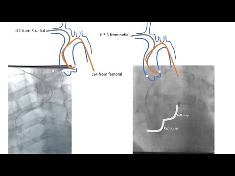 Left coronary engagement, radial and femoral: tips and case illustrations-Elias Hanna, Univ of Iowa