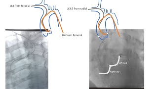 Left coronary engagement, radial and femoral: tips and case illustrations-Elias Hanna, Univ of Iowa