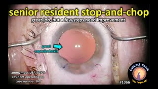 CataractCoach 1066: senior resident stop chop cataract surgery