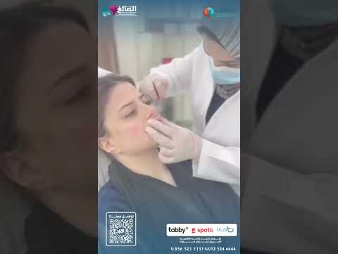 جلسة فيلر الشفايف في مجمع اطباء العصر بمكة المكرمة