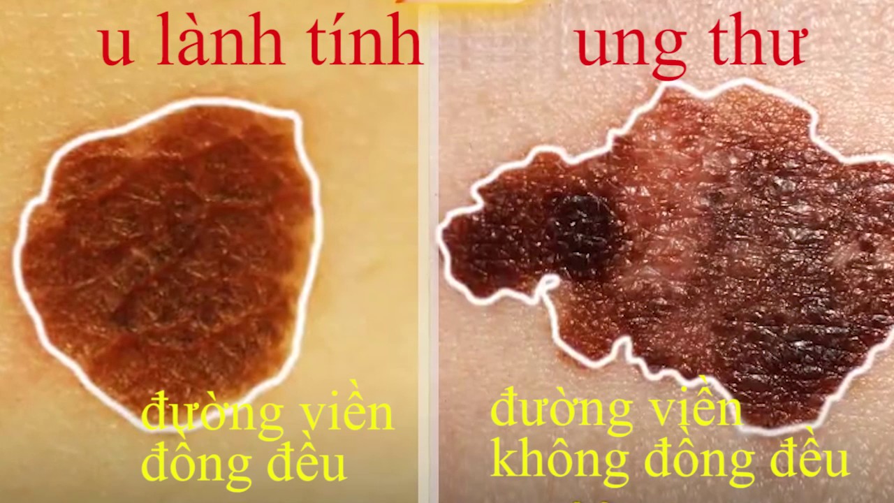 Ung thư da | Phân biệt Tổn thương da lành tính và ung thư da | Điều trị Ung thư - YouTube