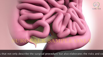 3D Animated Surgical Procedural Video - Sigmoid Colon Resection Sample SurgTalk Video
