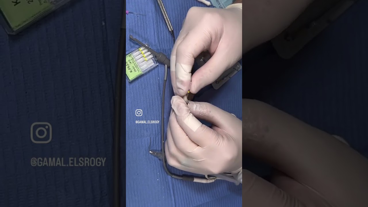 Instrumentation in Root Canal Treatment | خطوات التحضير الميكانيكي لحشو العصب