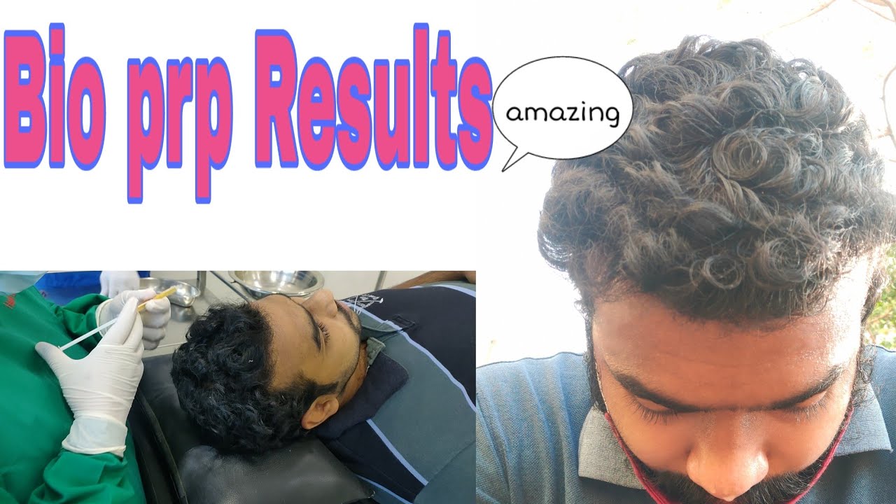 My Second Prp After Hair Transplant Cost Details Youtube