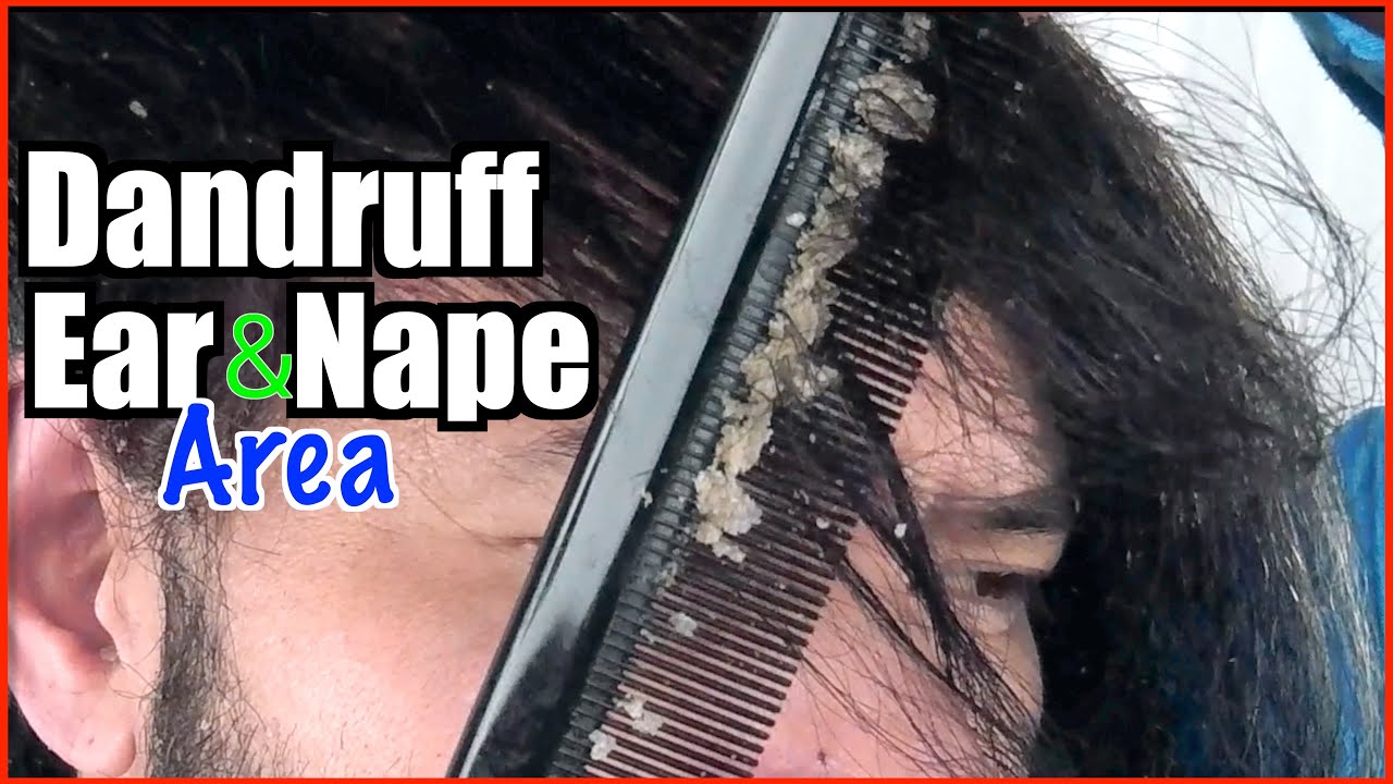 Behind Ear & Nape Area part1 2019 Montage DANDRUFF FLAKES