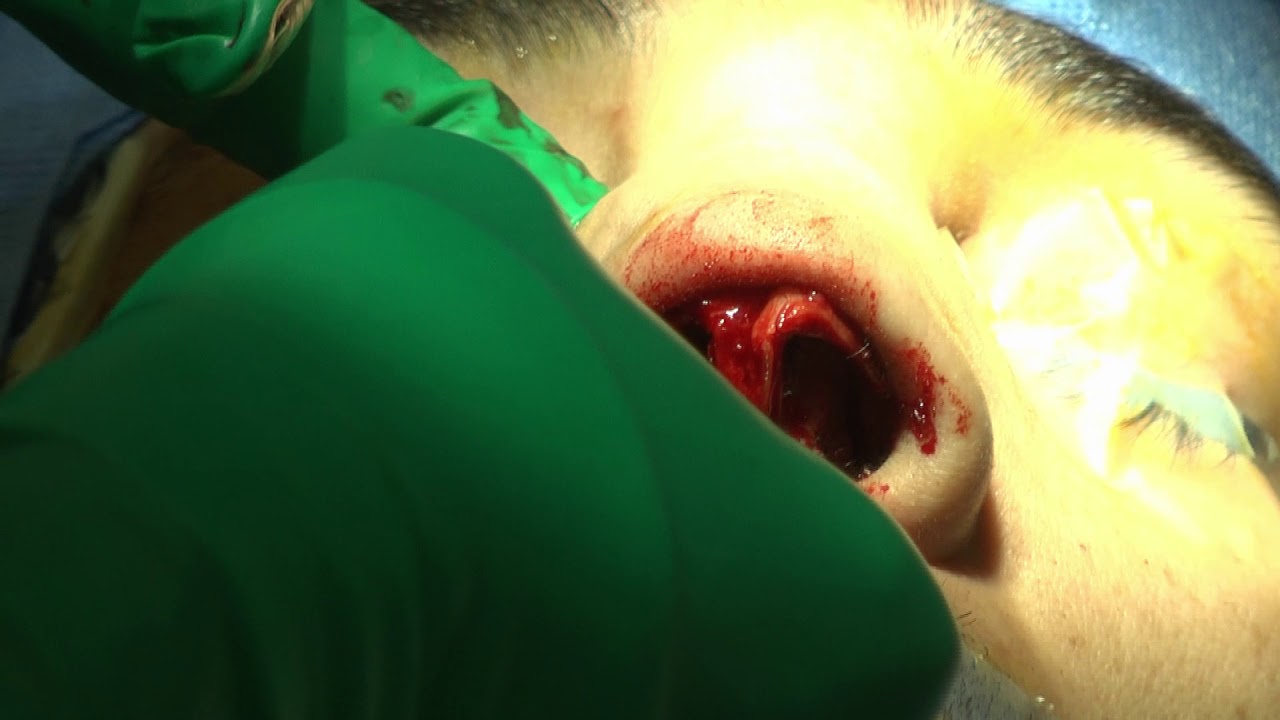 piezo rhinoplasty piezo rhinoplasty