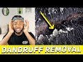 REACTING TO EXTREME DANDRUFF SCRATCHING AND REMOVAL (and tips for dry, flakey scalp!)