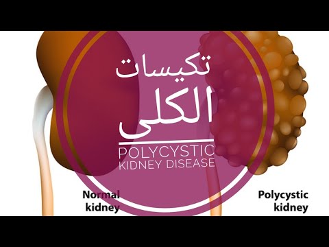 تكيسات الكلى (polycystic kidney disease) /د سوسن ناجي التميمي