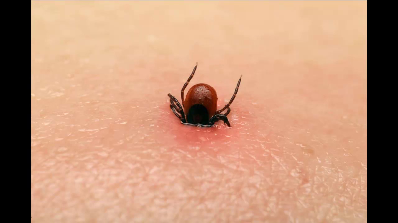 How Does Tick Bite Looks Like On Human Pimple Youtube