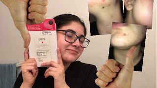 🤢WARNING GROSS CONTENT🤢 Trying out the Curesys Needle Pimple Patches| Fail
Discount Codes/Referal Links:
Use my rewards code at checkout on Yesstyle to receive 5% off https://www.yesstyle.com/en/home.html...
Use my code Zahra15 at checkout on https://www.peachpeach.store/ to receive 15% off. *I do not make any money from this code. It is just for you guys to use.*
Use my code Zahra10 at checkout on https://ferler.com/ to receive 10%. I do make a commission from this code.
Use my code ZahraMusa15 at checkout on https://korafitness.com/ to receive 15% off. I do make a commission from this code.
Use my referral code for https://www.thekpoptify.co/?rfsn=2274... I do make a commission for this code.
Use my code ZahraM10 at checkout on https://www.yihfoo.com/
I do make a commission from the code.
Use my code LVNAMUSA60 at checkout on https://la-venne.co/ to receive 60% off.
Dont forget to like, comment, and subscribe.
Twitter- https://twitter.com/zahramusa26
Instagram- https://www.instagram.com/ZahraMusa26/
Tumblr- https://www.tumblr.com/blog/zahramusa
Goodreads- https://www.goodreads.com/user/show/3...
Wattpad- https://www.wattpad.com/user/zahramusa26
Letterboxd- https://letterboxd.com/zahramusa26/
MyAnimeList: https://myanimelist.net/profile/zahra...
MyDramaList: https://mydramalist.com/profile
Pinterest: https://www.pinterest.ca/zahramusa41/
Polyvore: https://zahramusa.polyvore.com/
If youd like to connect me
email-zahramusa88@gmail.com 🤢WARNING GROSS CONTENT🤢 Trying out the Curesys Needle Pimple Patches| Fail