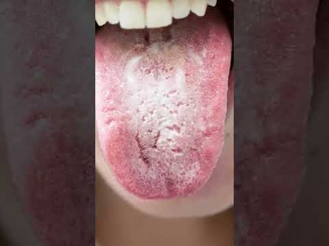 لماذا يتحول لسانك للون الأبيض أو الأصفر