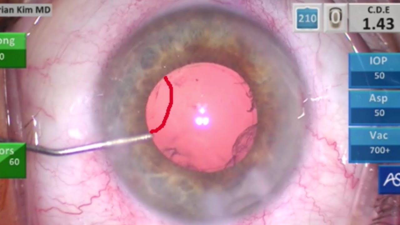 Posterior Capsule Rupture: Strategies to Minimize Vitreous Loss, Single ...