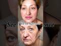 Small access, natural refinement. #facelift #facecontour