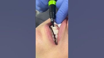 Composite bonding by Dr. Charlie. 👏 #ruhdental #compositebonding