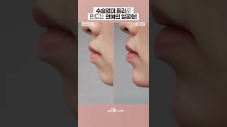나 돌출입, 무턱인데 후기 미쳤다. 진짜🫢 #필러 #무턱필러 #턱필러