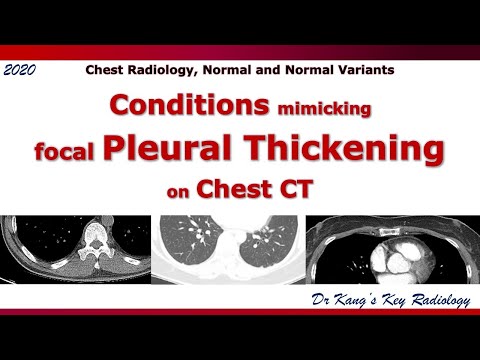 Pleural thickening mimickers, CT