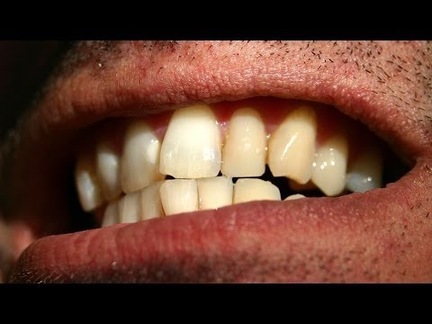 Video: Crooked Teeth: Příčiny, Obavy A Jak Se Narovnat