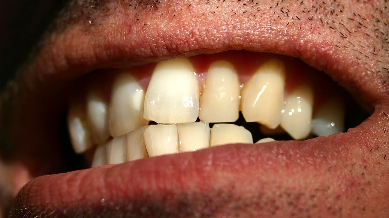 How To Fix Just One Crooked Tooth