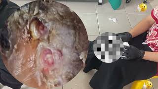 Hidden Jigger Infestation Rotten Skin Peeled Away