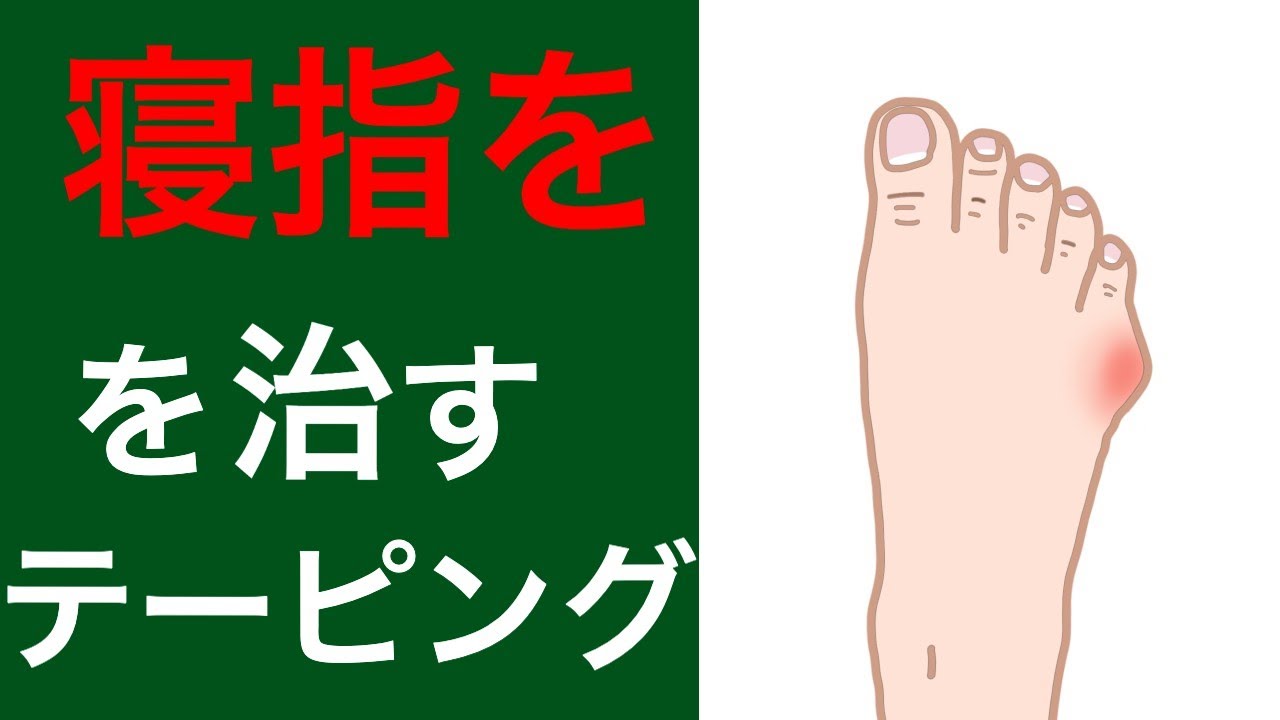 寝指 内反小趾を治すためのテーピング方法 足の悩み解消専門チャンネル Youtube