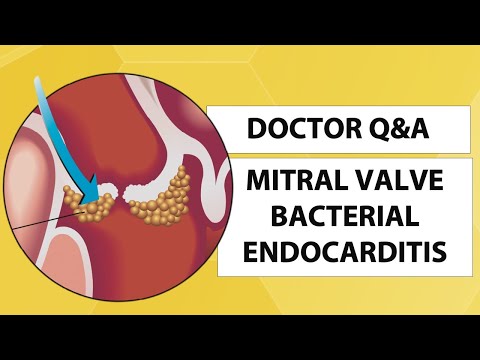Video: Kde se v těle nachází endokarditida?