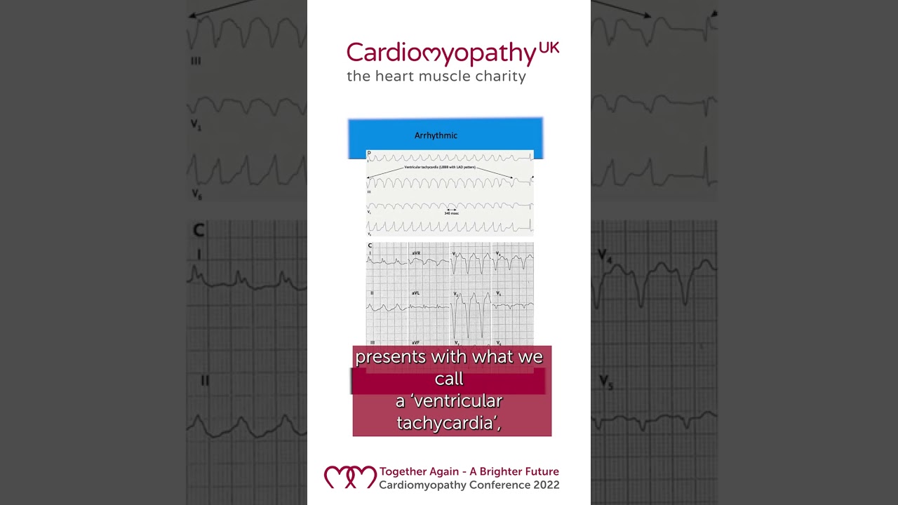 Diagnosing Arrhythmogenic Cardiomyopathy (ACM)