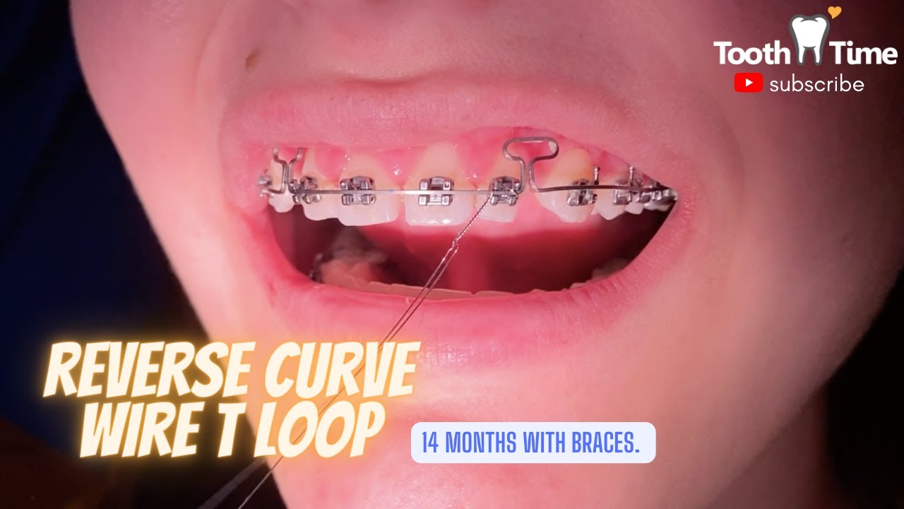 What does a reverse curve wire do for braces? Tooth Time Family Dentistry  New Braunfels Texas 