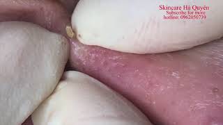 Best of deep blackheads at Ha Quyen spa