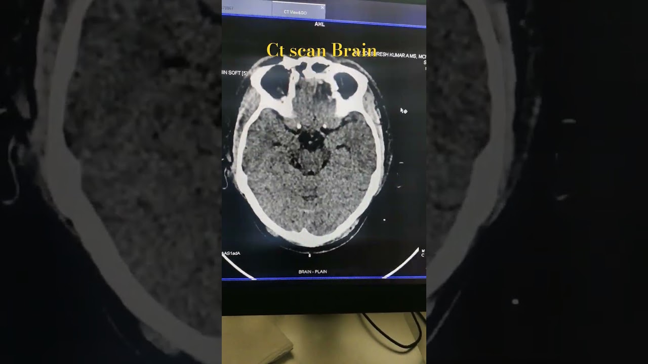 Ct brain 