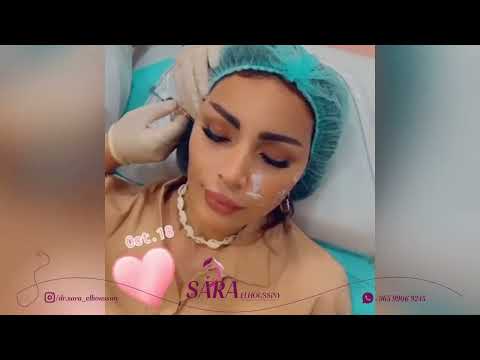 شاهد عملية حقن فيلر الخدود مع د سارة الحسيني