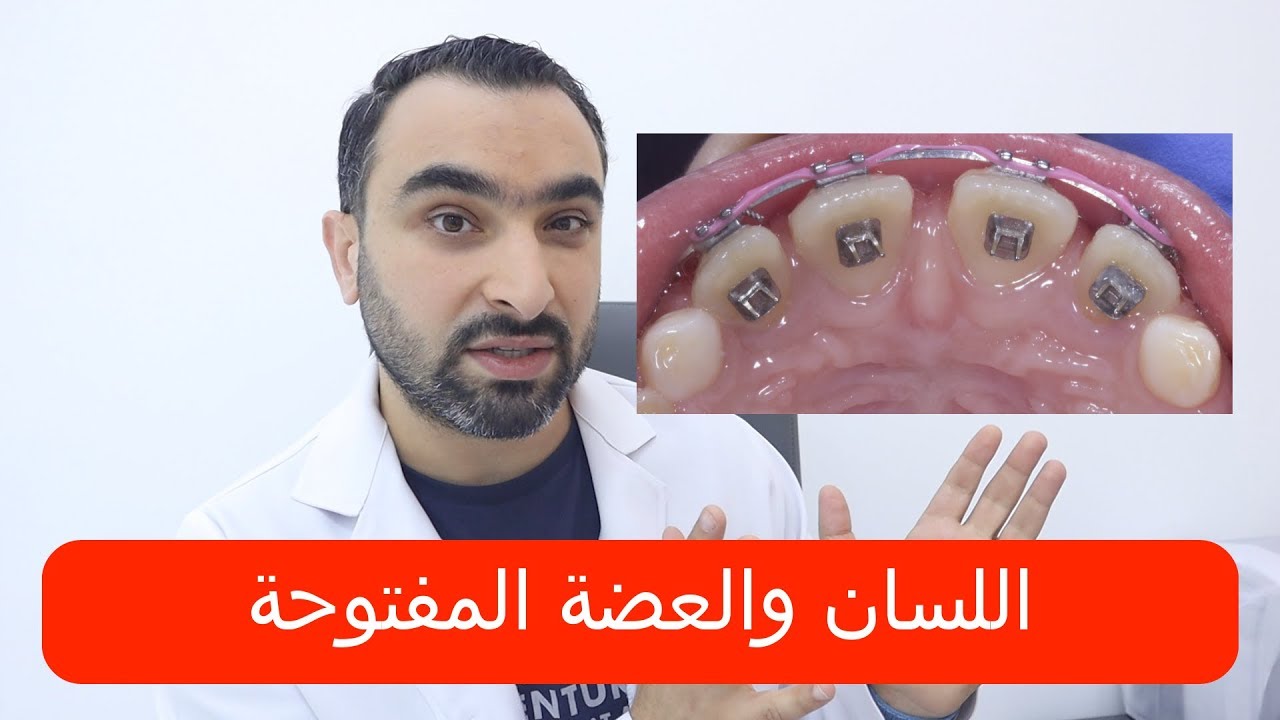 ما هي علاقة اللسان مع العضة المفتوحة؟ | د.محمد صادقلي