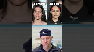 Buccal Fat Removal Trend