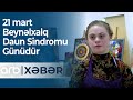 21 mart - Beynəlxalq Daun Sindromu Günüdür  – ARB Xəbər