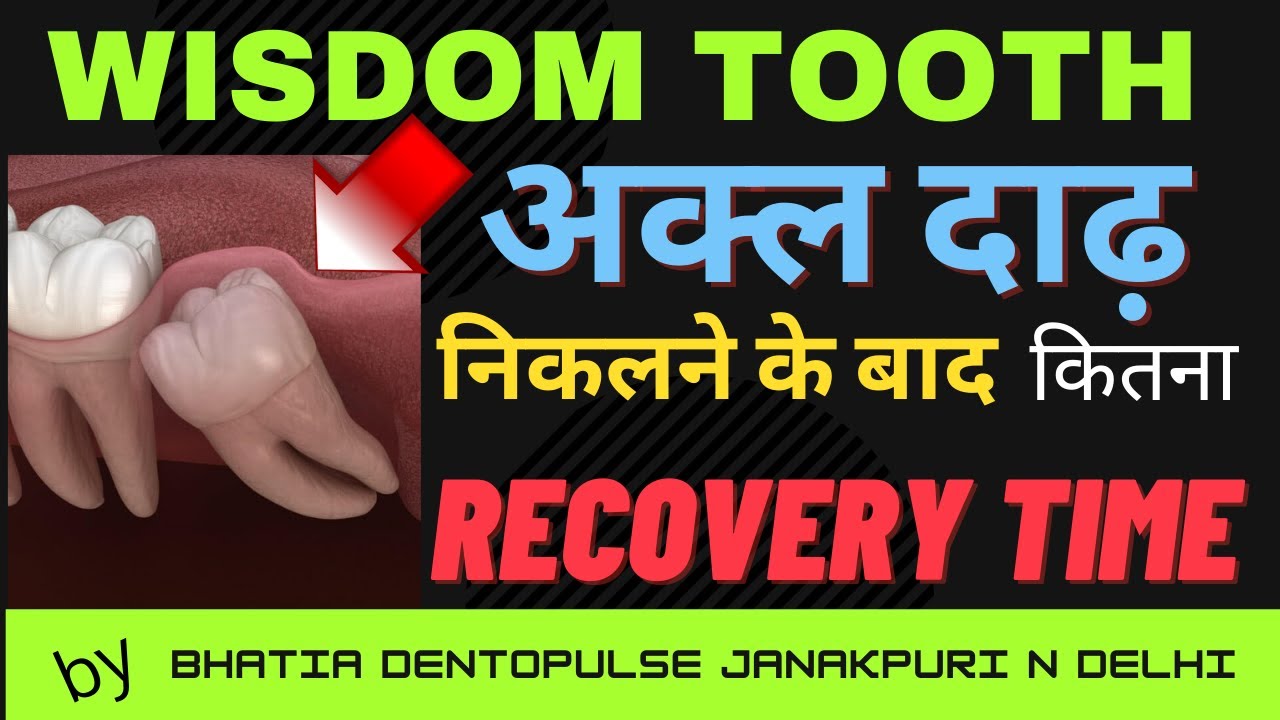अक्ल दाढ़ निकालने के बाद ठीक होने में कितना लगता हैं समय-Recovery time after Wisdom Tooth extraction